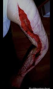 coldnessinmyheart a horrible self harm case :snooze::snooze: - WPD