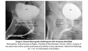 Image result for Retrograde Urethrogram