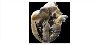 Image result for Cor Pulmonale