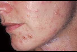 In general, a person can only get. Varicella Zoster Virus Infection Face Picture Image On Medicinenet Com