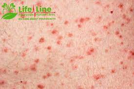 It causes sudden red, raised, blistery, and sometimes very itchy spots that form around the middle of the body. Ayurvedic Herbal Treatment Of Grover S Disease Transient Acantholytic Dermatosis In Adelaide Sa