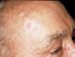 Skin cancer may initially appear as a nodule. Basal Cell Carcinoma The Skin Cancer Foundation