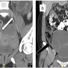 Find out about ct head scanning indications at patient.info. Pdf Characterization Of Adnexal Masses Using Multidetector Contrast Enhanced Ct Scan Recognising Common Pitfalls That Masquerade As Ovarian Cancer