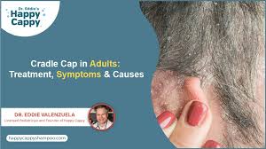Image result for Cradle Cap
