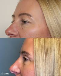 Exceptional Plastic Surgery Experience with Dr. Chuck Schafer