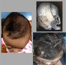 ما هي الحالات المناسبة لجراحة التحام عظام الجمجمة بالمنظار؟Ramamurthy, 2020