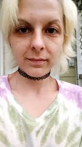 This is my daughter Sara. She has NF 1. She has migraines and leg pains.  She has a plexiform