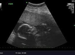 Baby S Head Measuring Small At 24 Week Ultrasound Babycenter