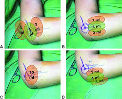 Image result for Epicondyle Injection