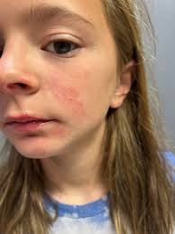 What helps clear chlorine rash