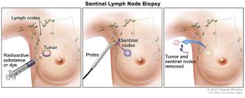 Many people choose to tell their partner or spouse first, followed by close family members and living beyond breast cancer: Lymph Node Removal In Early Stage Breast Cancer National Cancer Institute