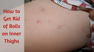 Home remedies to remove boils on butts. How To Get Rid Of Boils On Inner Thighs