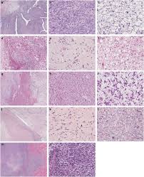 malignant phyllodes tumors are rare breast neoplasms that are associated with a 6.2% to 25% incidence rate of distant metastasis the lung is the most common metastatic site. Genomic Profiling Of Malignant Phyllodes Tumors Reveals Aberrations In Fgfr1 And Pi 3 Kinase Ras Signaling Pathways And Provides Insights Into Intratumoral Heterogeneity Modern Pathology