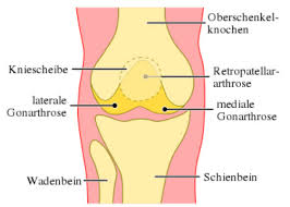 Osteoarthritis (oa) and rheumatoid arthritis (ra) affect a large proportion of the population. Arthrose Oder Gelenkverschleiss