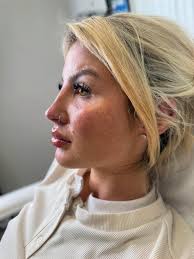 Profile harmony with @teoxane_uk filler ⚖️ Tear trough ✔️ Nose ✔️ Cheek ✔️  Lips ✔️ Chin ✔️ For more information DM or contact 07962183688  #ProfileBalancing #FacialAestheticsScotland #GlasgowAesthetics  #EdinburghAesthetics ...