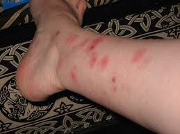 Bug Bite Black And Blue Ring How To Get Rid Of Bug Bites Home Remedies For Rashes Bed Bug Bites Remedies Bed Bug Bites