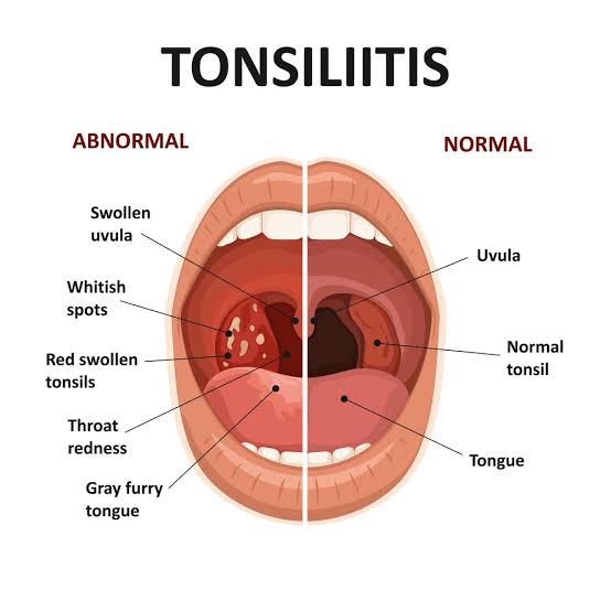 Tonsil Stones: The Hidden Source of Your Bad Breath - Integracare Clinic