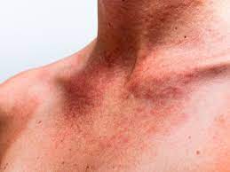 Top 10 Best Home Remedies For Sun Poisoning Sun Allergy Skin Allergies Human Energy Field