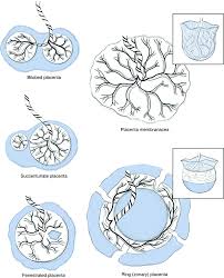 The placenta is a temporary fetal organ that begins developing from the blastocyst shortly after implantation. Placental Shape Aberrations Springerlink