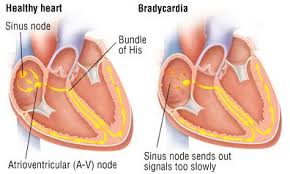 Bradycardia Causes Symptoms Treatment Options Drugs Com