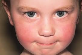 Image result for yellow scabs on the face in children