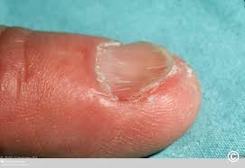 Image result for Koilonychia feet