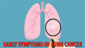Lung cancer is the leading cause of cancer deaths among adults in the united states. Some Of The Early Common Symptoms Of Lung Cancer Iwmbuzz