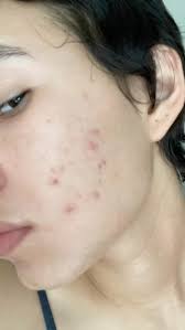 Ready for a Glow-Up? Come See the Power of a HydraFacial Transformation!,  HydraFacials are more than just a treat—they're a total skin reset. Whether  you're looking to refresh your glow or target ...