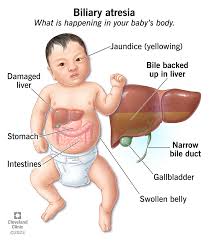 Image result for acholic stools human