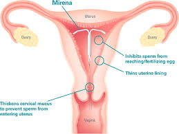 About Mirena Iud