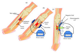 Basically, the bone stimulator works by delivering ultrasonic or pulsed electromagnetic waves to the site of the fracture to kick start the healing process. Bone Stimulation Represents New Frontier For Optimizing Patient Outcomes Lower Extremity Review Magazine