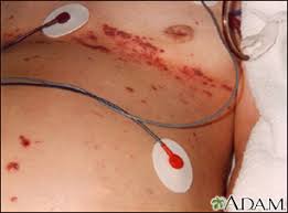 Image result for herpes zoster