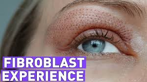 Fibroblast Treatment Experience Before And After 7 Days Youtube
