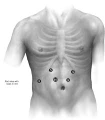 The platysma is divided and dissection is continued medially to the sternocleidomastoid muscle, carotid sheath, and laterally to the trachea and the thyroid. Technique Of Minimally Invasive Ivor Lewis Esophagectomy Operative Techniques In Thoracic And Cardiovascular Surgery