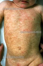Image result for Urticaria pigmentosa children