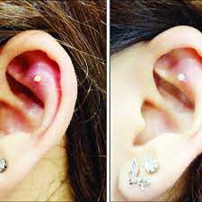Pdf Common Complications After Auricular Piercing In Korea Case Reviews And Treatment