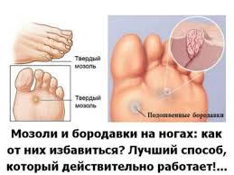 как избавиться от запаха на ногах в домашних условиях Kak Izbavitsya Ot Mozoli I Borodavki Na Nogah Body Care Pedicure Health