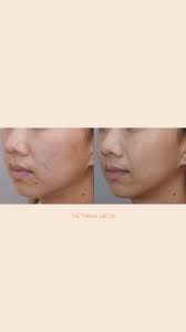 Vivace Rf Microneedling Before and After