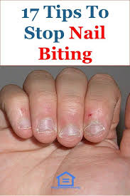 How To Stop Nail Biting 17 Tips In 2020 Nail Biting Nails For Kids Nail Biting Remedies