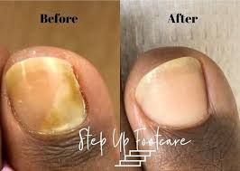 Epsom salt in a bowel and toenail fungus before and after treatment. Laser Toenail Fungus Treatment Podiatrist Nyc Downtown Step Up Footcare