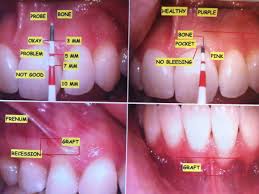 Was told by dr to take it easy for three days after. What It S Like To Get Gum Grafting Surgery Patient S Lounge