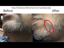 White hair treatment products on the site are advanced formulations of rich minerals such as keratin, formaldehyde keratin protein, and more, that nourish your hair and treat it in the best. Treatment Of White Hairs On Face Permanently Ø¯ÛŒØ¯Ø¦Ùˆ Dideo