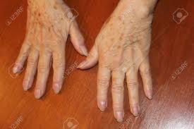We did not find results for: Hands Of A Female Senior Citizen With Age Spots Stock Photo Picture And Royalty Free Image Image 34435134