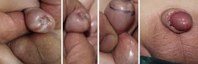 Image result for Phimosis