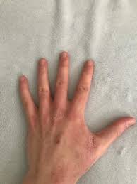 Unser sortiment umfasst verschiedene pflegeprodukte für trockene, beanspruchte und sensible haut. Habe Ich Neurodermitis Warum Sind Meine Hande So Haut Juckreiz Hand