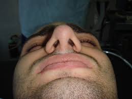 Simple methods like shaving and clinical procedures like laser hair removal and electrolysis can give good results. How To Remove Nose Skin Excess Aesthetically Reasonable Approach