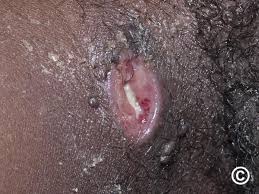 Image result for Chancroid