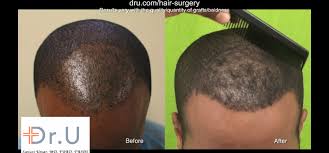 Linear scar free black hair restoration 1 year after surgery.* Achieve The Best Success Rates For African American Hair Transplants With Dr Ugraft The Dr Ugraft Zeus System