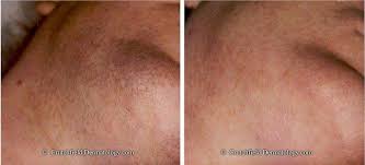 In this review, we want to get all the data about the laser hair removal process. Laser Hair Removal Crutchfield Dermatology Eagan Minnesota
