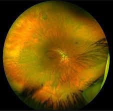 Optos retinal imaging the optos imaging technology allows us to give our patients a more thorough health evaluation. Flashes Floaters Retinal Detachment Vitreous Gelly